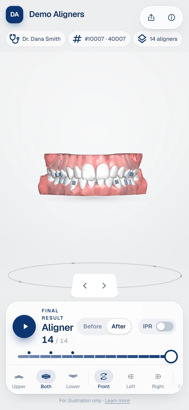Aligner before and after simulation on a phone showing the final result